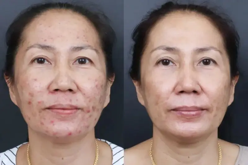 Trị thâm mụn có chi phí dao động lớn, tùy vào từng phương pháp