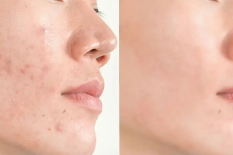 Điều trị thâm mụn cần thời gian để da hồi phục