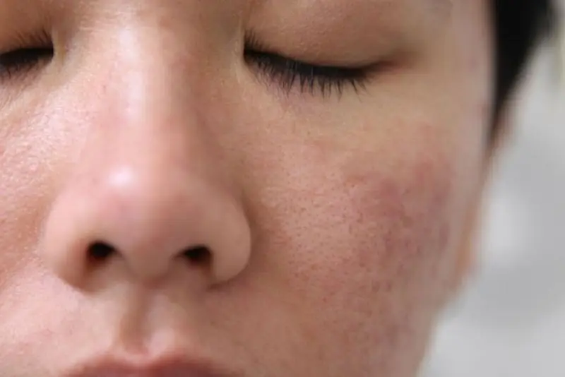 Thay đổi hormone trong thai kỳ khiến da thâm sạm