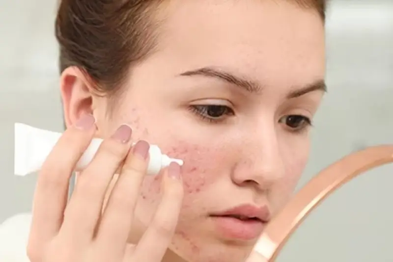 Dùng hoạt chất trị thâm
