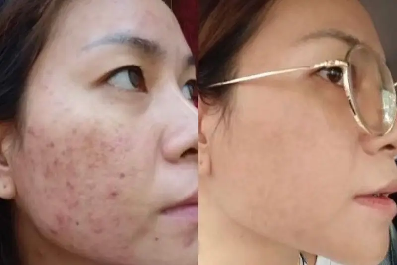 Khách hàng hết thâm sau 1 liệu trình điều trị