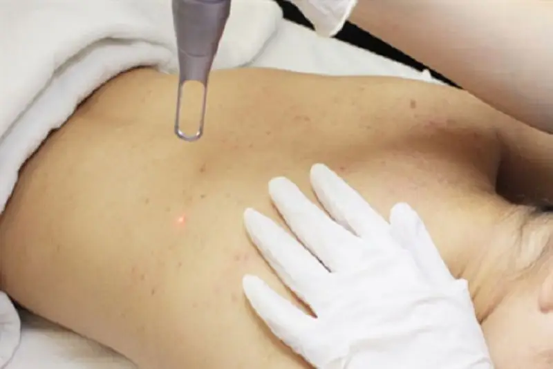 Liệu pháp laser chuyên sâu được áp dụng khi vết thâm lâu năm khó điều trị tại nhà