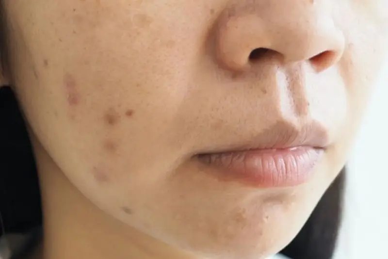Vết thâm lâu năm cần áp dụng công nghệ hiện đại