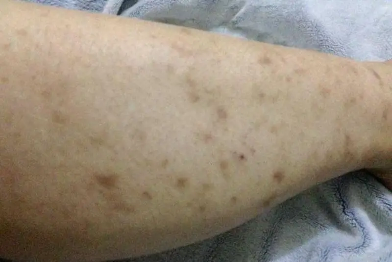 Nên bắt đầu điều trị thâm ở chân ngay khi thâm xuất hiện