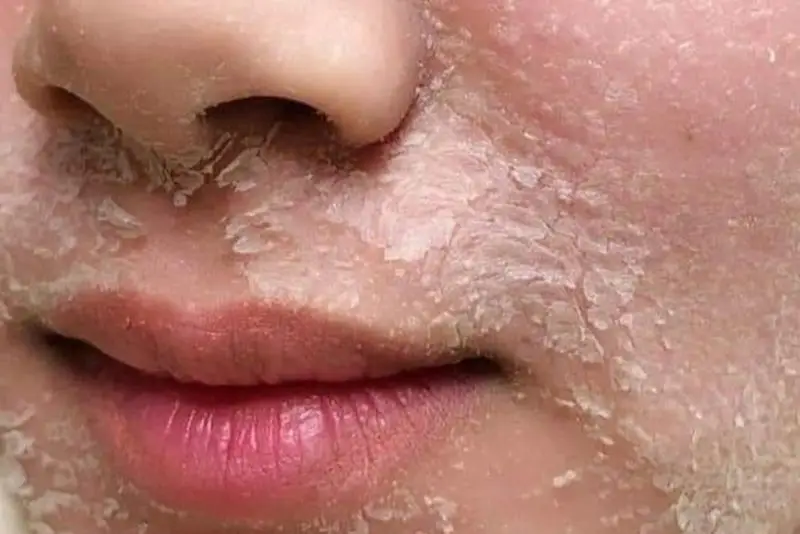 Peel da