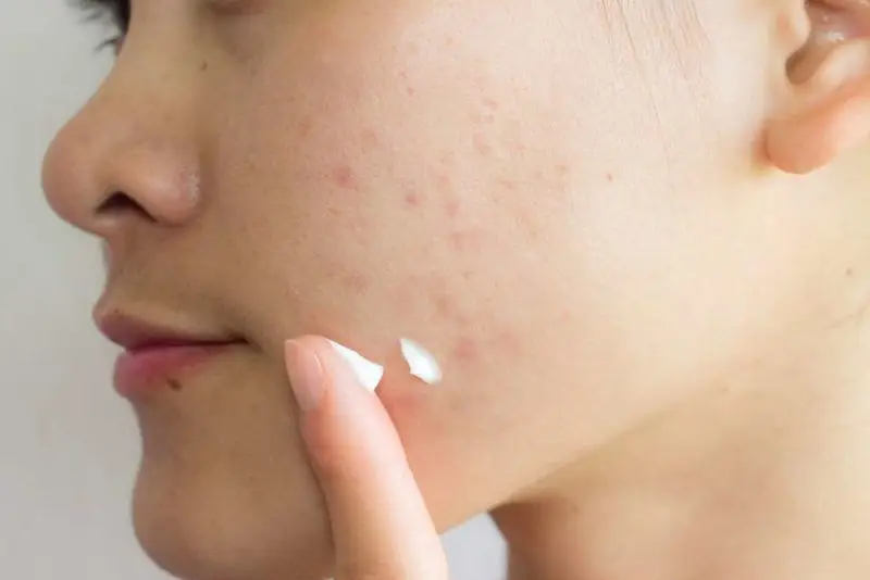 Sử dụng kem đặc trị thâm