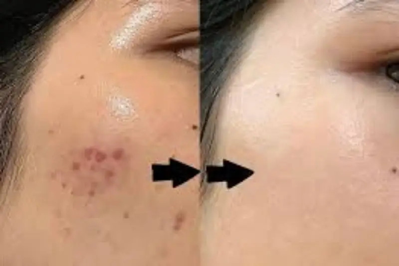 Trị thâm mụn trong 7 ngày