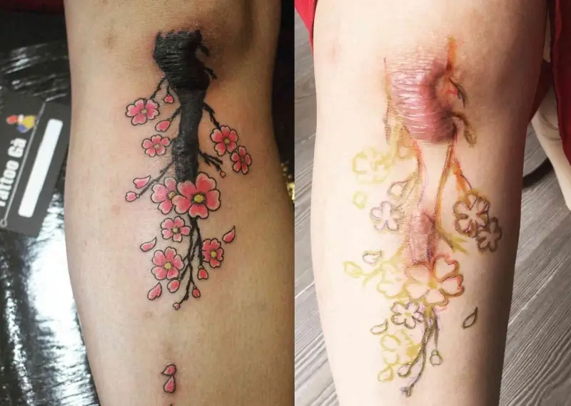 Có thể xăm hình sau khi vết sẹo hình thành ổn định