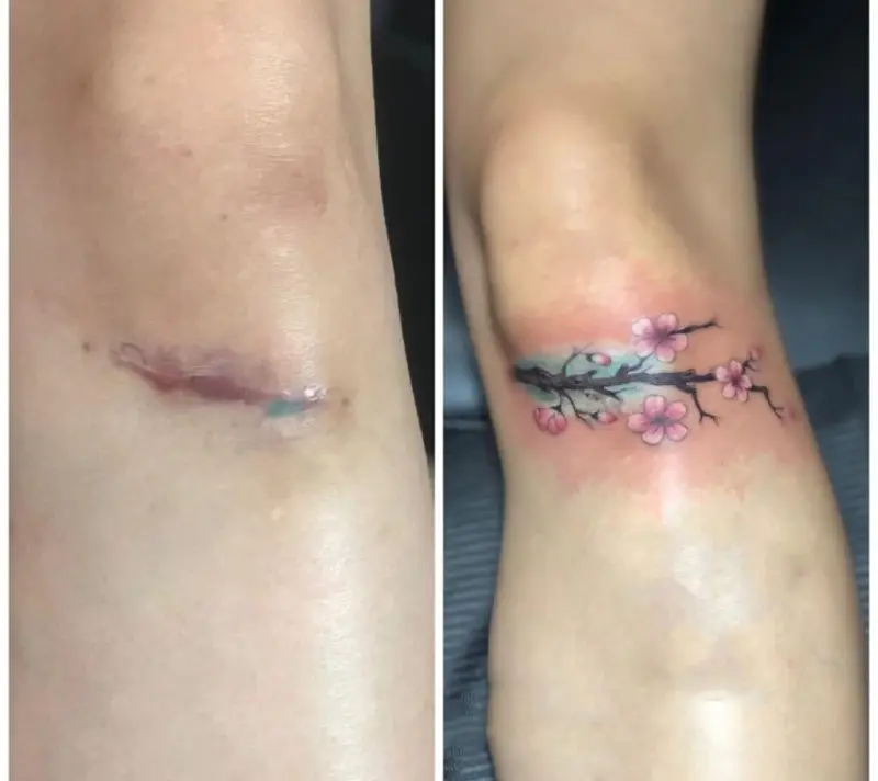 Có thể xăm hình tùy vào mức độ của sẹo lồi