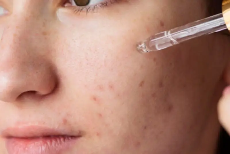 Vitamin C trị thâm mụn hiệu quả nhờ ức chế enzym tyrosinase