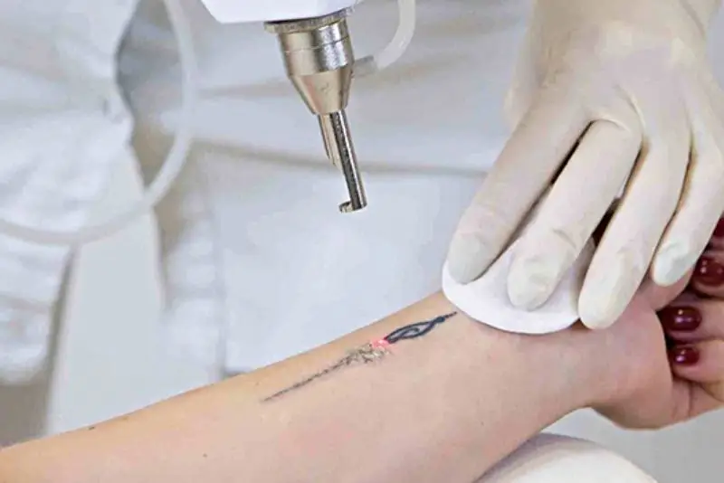 Nên xóa xăm tại cơ sở uy tín