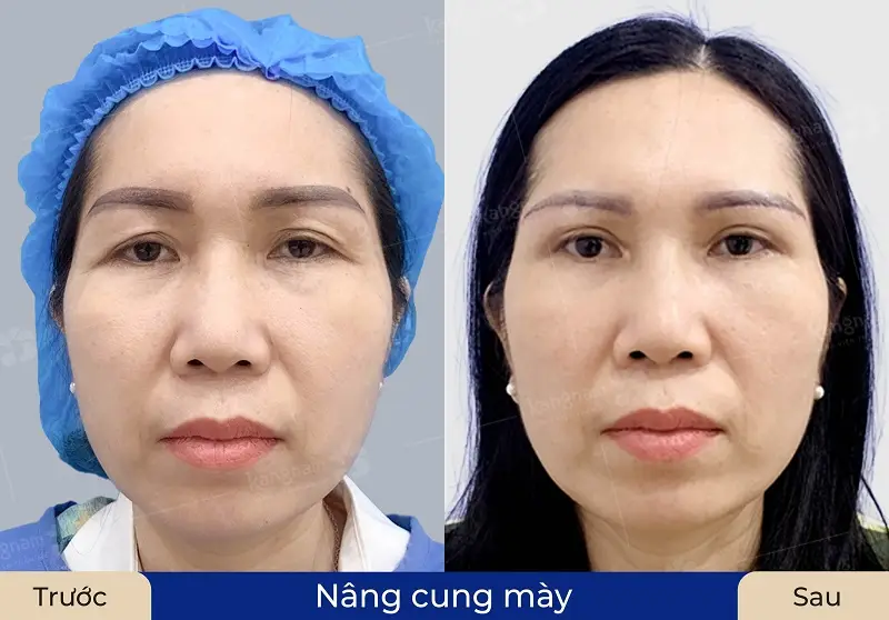Nâng cung chân mày với trường hợp đã có nếp mí nhưng do lão hóa, da chảy xệ