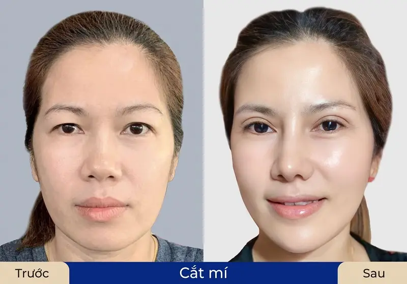 Cắt mí giúp tạo nếp mí đều, tự nhiên và cân đối