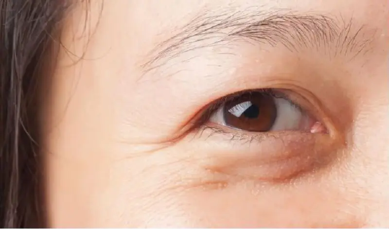Bọng mắt có nếp nhăn hình thành do tốc độ lão hóa của cơ thể
