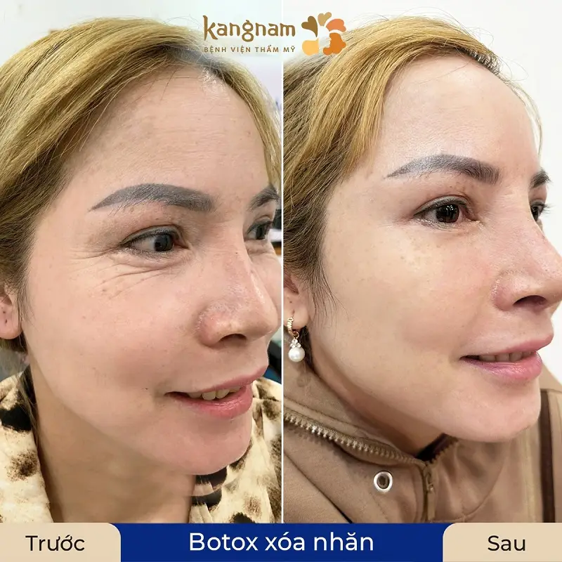 Tiêm botox giúp xóa nhăn bọng mắt