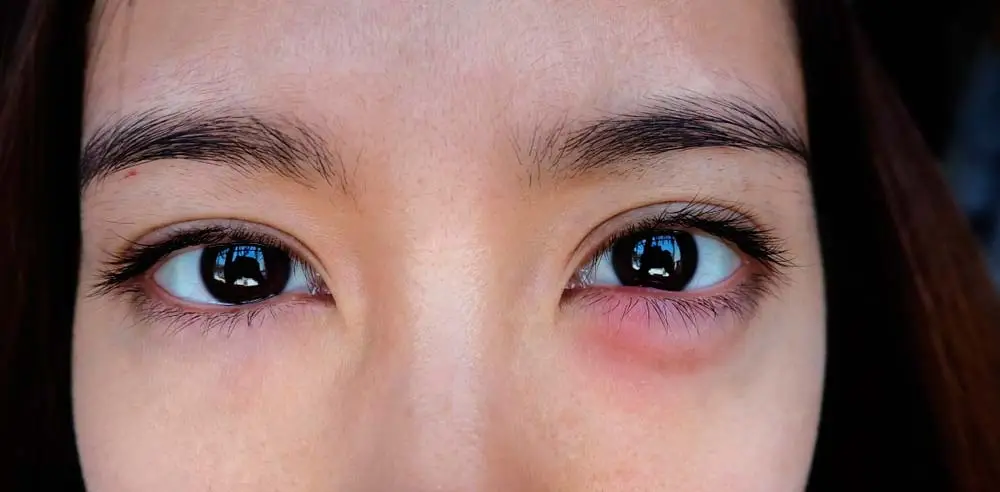 Mắt bị dị ứng gây sưng bọng mắt