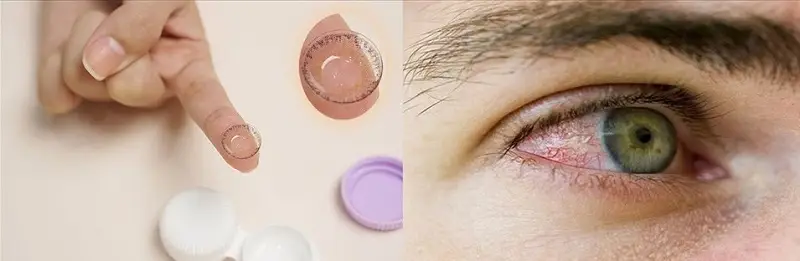 Sử dụng kính áp tròng không đúng cách