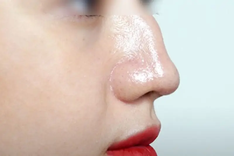 Mũi gãy ở phần sống mũi bị lệch, cong hoặc có điểm gấp khúc rõ ràng