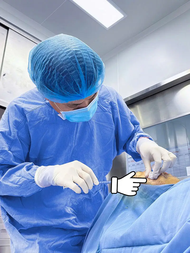 Mỡ tự thân được cấy vào vùng hốc mắt đúng quy trình
