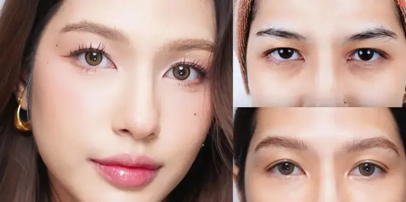 Cấy mỡ tự thân tại cơ sở thẩm mỹ uy tín