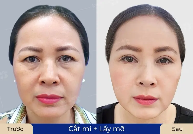 Lấy bọng mỡ mí mắt dưới giúp đôi mắt tươi trẻ hơn