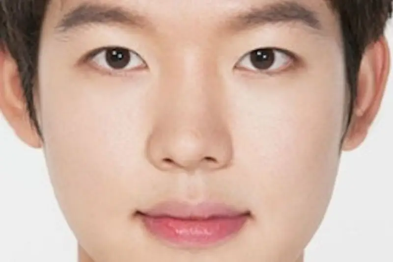 Cánh mũi bên cao bên thấp thường do lệch vách ngăn mũi, đây là tình trạng vách ngăn giữa hai lỗ mũi bị dịch chuyển sang một bên