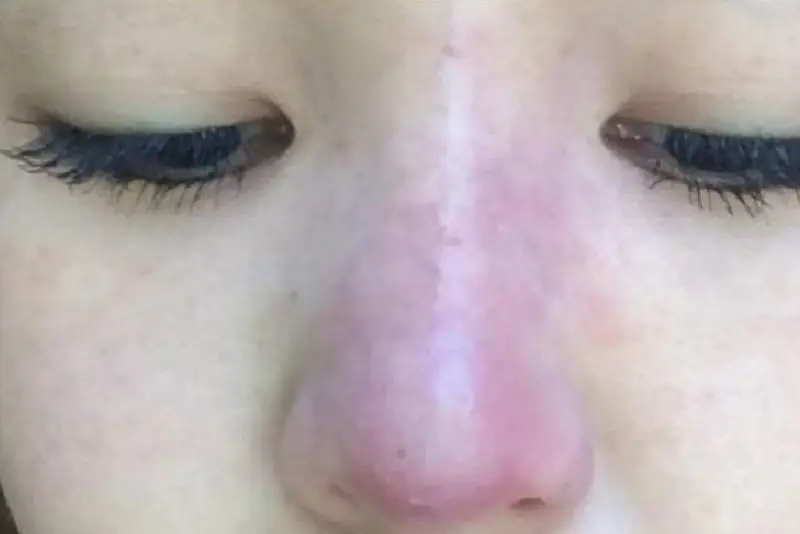 Biểu hiện nhiễm trùng sau nâng mũi