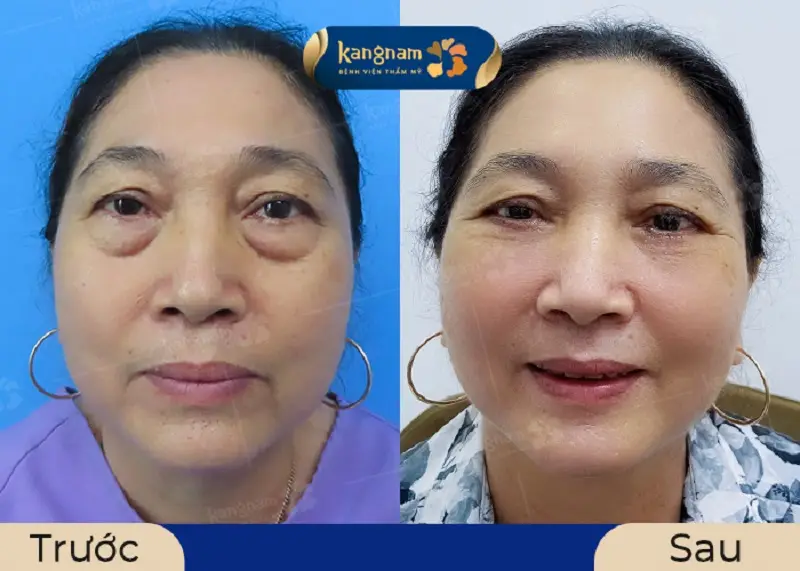 Khách hàng sau lấy mỡ bọng mắt gương mặt tươi trẻ hơn