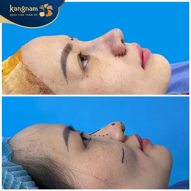 Sưng sau khi thu gọn cánh mũi thường chỉ kéo dài từ 5–7 ngày