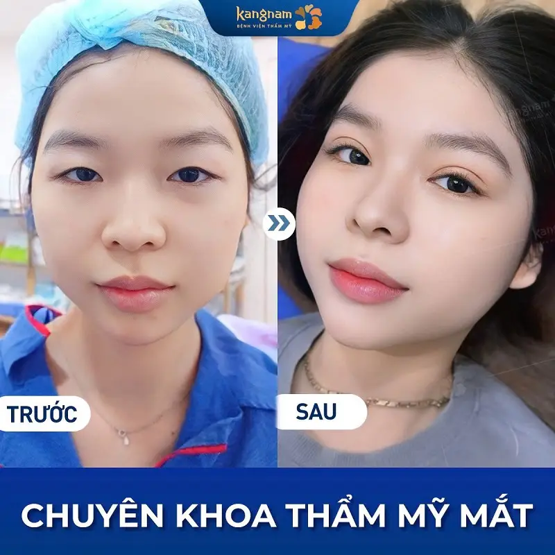 Sau cắt mí giúp gương mặt tươi trẻ hơn, nhưng không ảnh hưởng quá nhiều khi xuất nhập cảnh