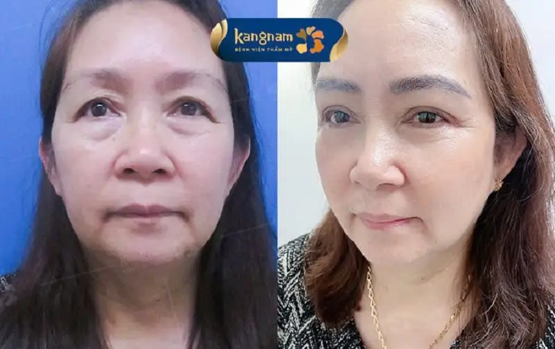 Sau cắt mí dưới đôi mắt khách hàng tươi trẻ và rạng ngời hơn