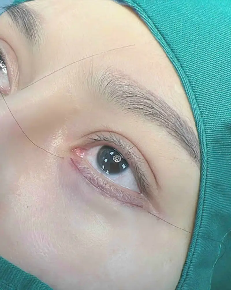 Cắt mí dưới giấu chỉ loại bỏ tình trạng bọng mắt già nua, mệt mỏi