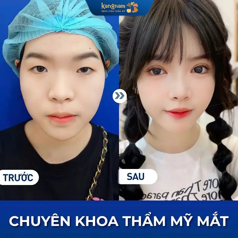 Lựa chọn cắt mí để khắc phục tình trạng mắt 1 mí, tạo đôi mắt to tròn, cân đối