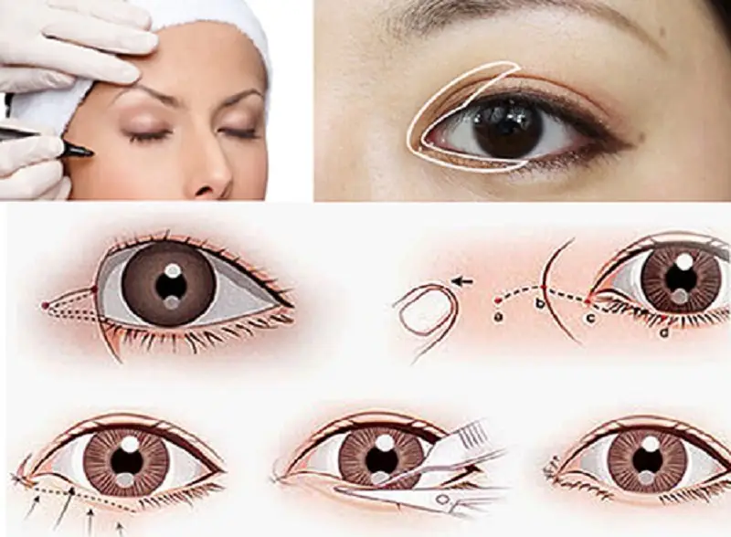 Mở góc mắt giọt lệ Trung Hoa là dáng mắt được nhiều người yêu thích