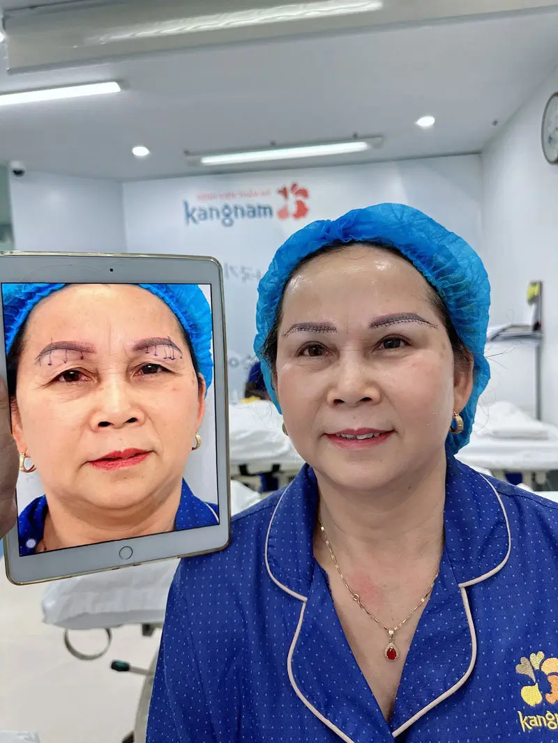 Nâng cung chân mày giúp khắc phục tình trạng da chùng nhão, chảy xệ ở vùng mí mắt