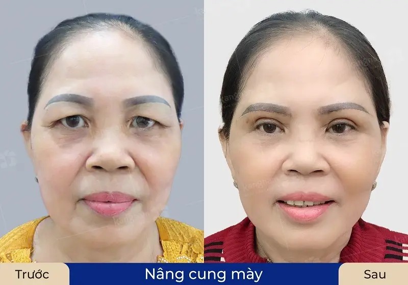 Vết thương phục hồi ổn định sau nâng cung chân mày khách hàng mới nên xăm mày