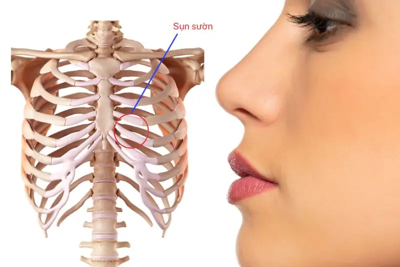 Nâng mũi sụn sườn