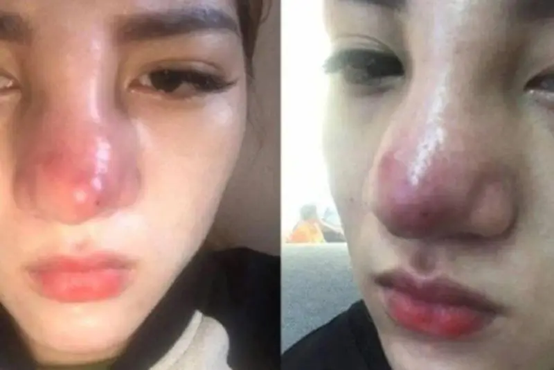 Biến chứng do nâng mũi sai quy trình, dùng sụn kém chất lượng