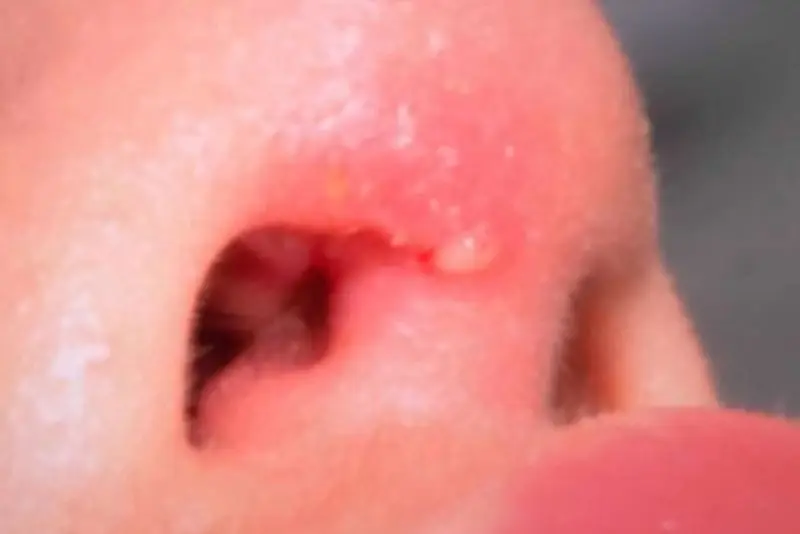 Tập luyện quá sớm có thể làm rách vết mổ