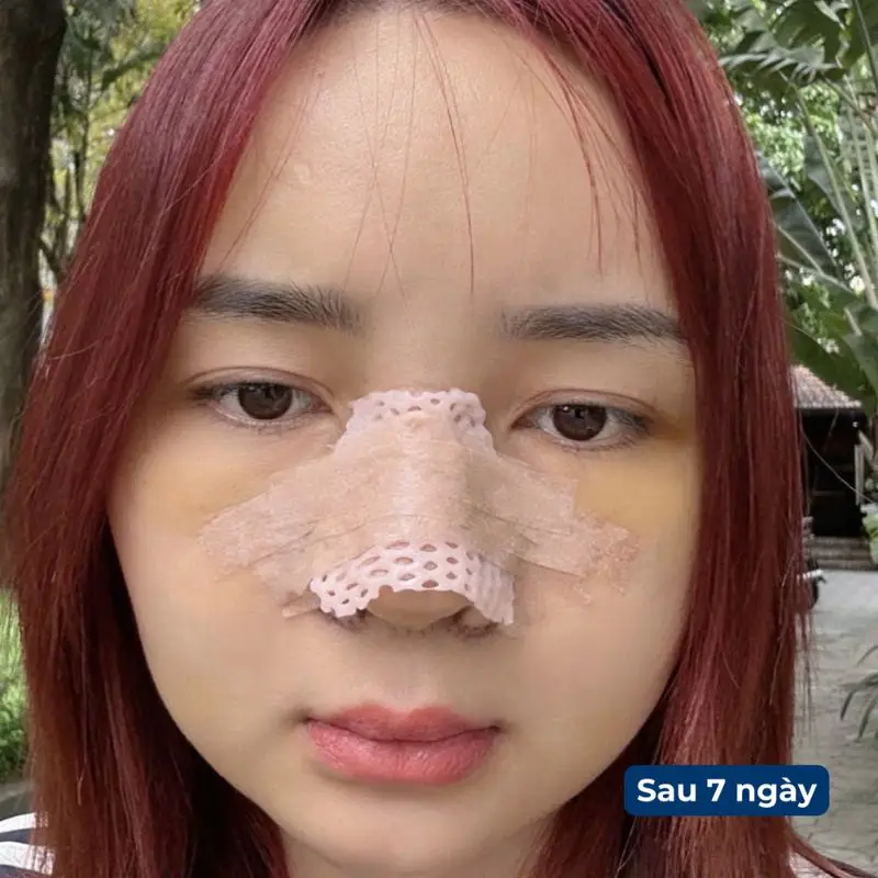 Nâng mũi bán cấu trúc tháo nẹp
