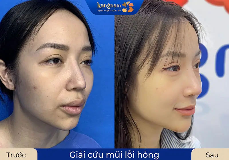 Khách hàng thực tế sau khi sửa mũi lần 2 tại Kangnam