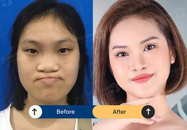 Cải thiện chức năng hô hấp