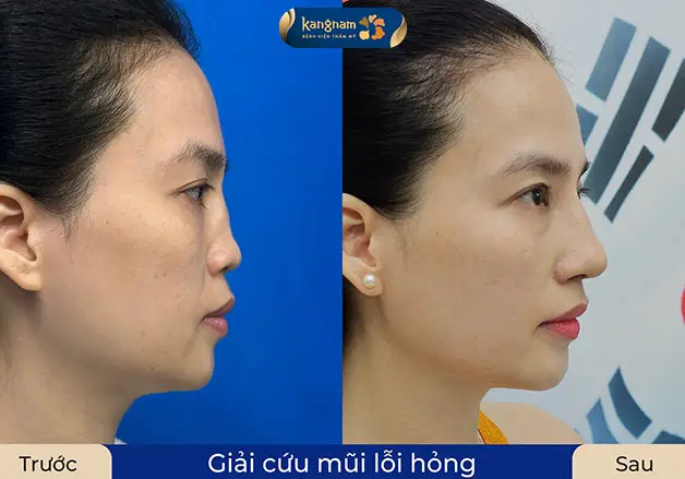Sửa mũi hỏng kết hợp thay sụn bằng vật liệu sinh học cao cấp