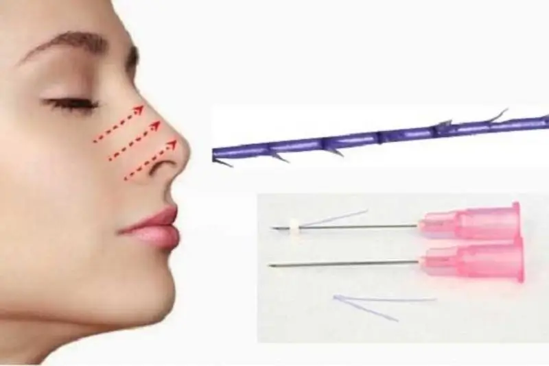 Chỉ sinh học tự tiêu an toàn, không cần rút chỉ sau khi thực hiện