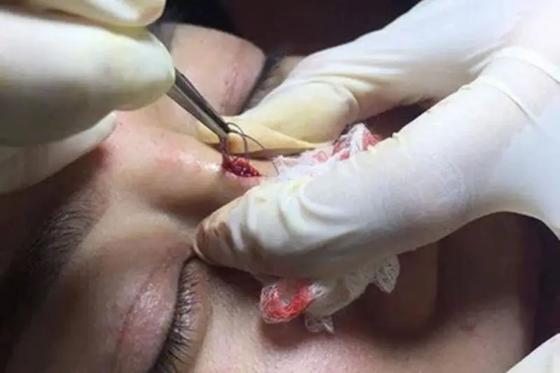 Khách hàng gặp biến chứng cần tháo chỉ mũi