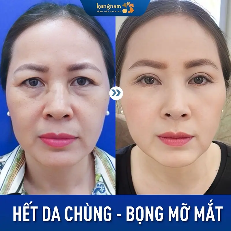 Vùng mí mắt dưới không để lại sẹo, xóa sạch da chùng, bọng mỡ