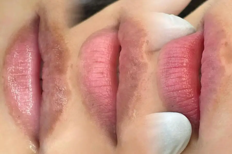 Khử thâm môi giúp loại bỏ sắc tố gây thâm sạm