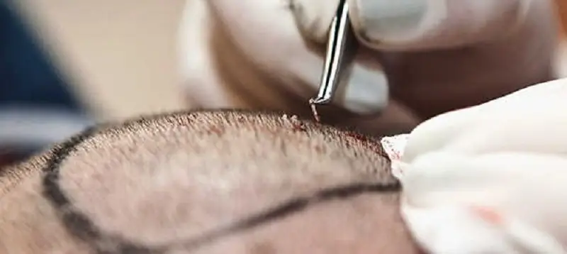 Chi phí cấy tóc tùy thuộc vào số lượng nang tóc