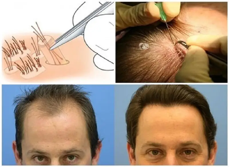 Cấy tóc đảm bảo an toàn khi thực hiện đúng kỹ thuật
