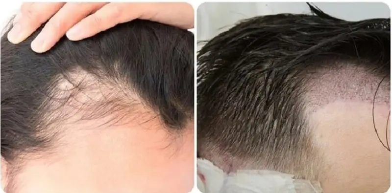 Các nang tóc sau khi thích nghi với vùng da đầu sẽ phát triển tự nhiên